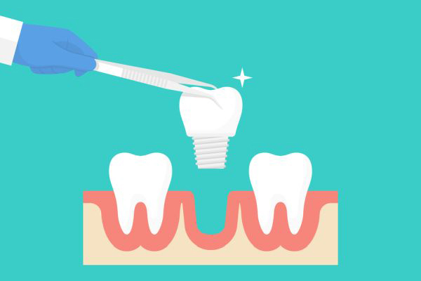 Dental implants