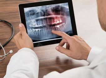 Types of Dental Root Fractures